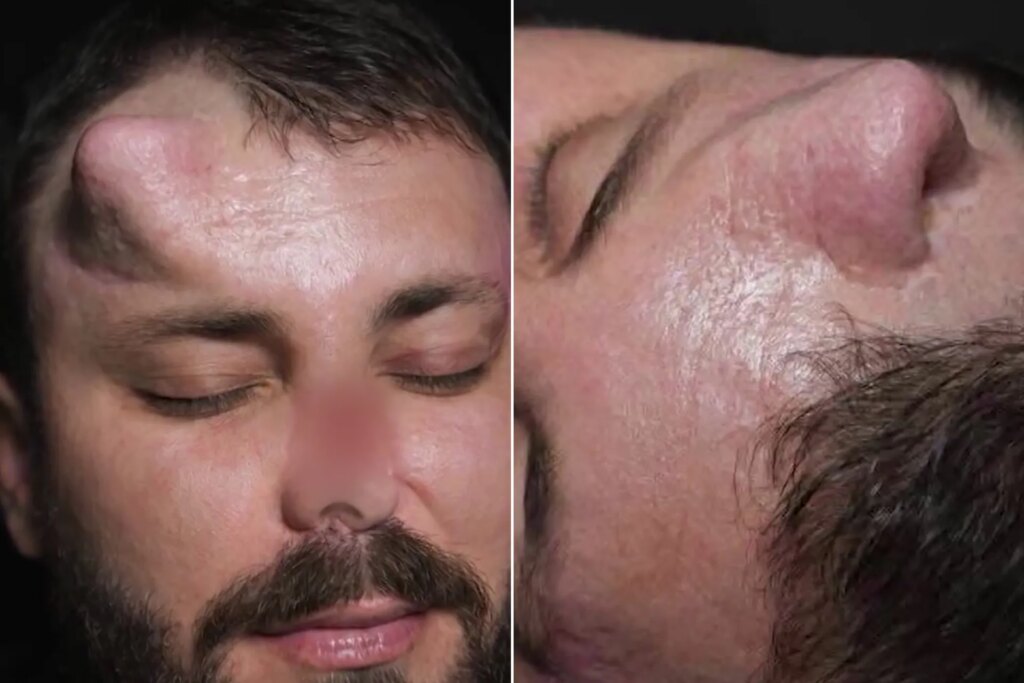 جراح عراقي يعيد بناء أنف عامل في جبهته